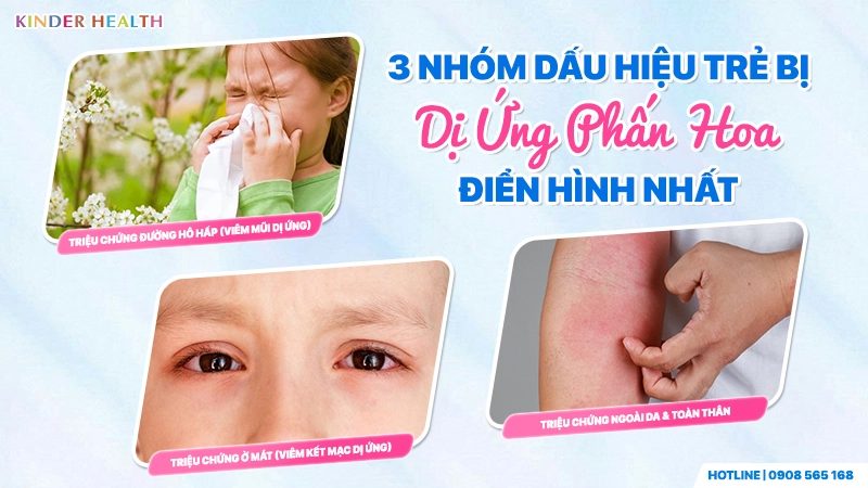 3 nhóm dấu hiệu trẻ bị dị ứng phấn hoa - Triệu chứng hô hấp (viêm mũi ứng), viêm kết mạc mắt, viêm da hoàn toàn toàn thân