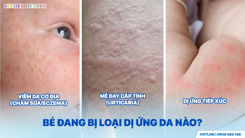 "Ba loại dị ứng da ở trẻ: viêm da cơ địa, mề đay cấp tính, dị ứng tiếp xúc với hình ảnh minh họa từng triệu chứng.