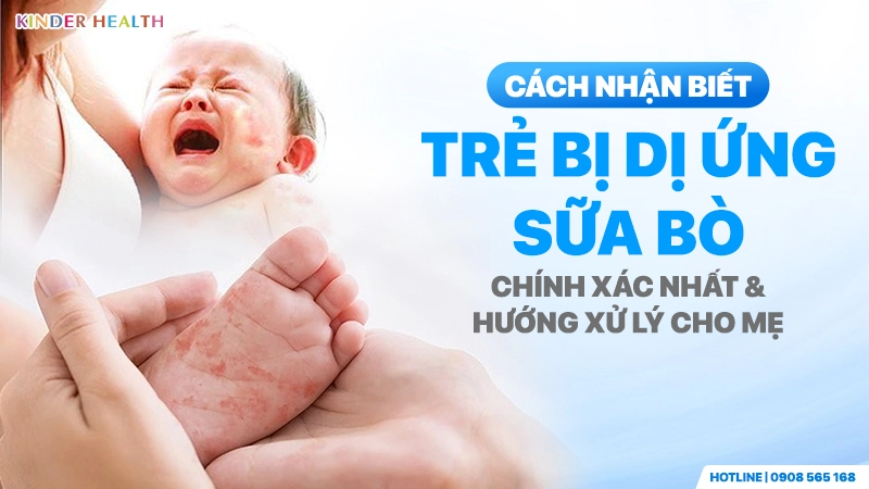 Cách nhận biết trẻ bị dị ứng đạm sữa bò qua các dấu hiệu ngoài da và hướng xử lý cho mẹ tại KinderHealth
