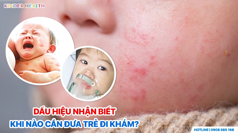 Trẻ bị nổi mẩn đỏ khắp mặt và khó thở - Dấu hiệu sốc phản vệ do thực phẩm