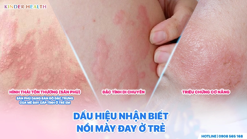 Dấu hiệu nhận biết dị ứng nổi mày đay ở trẻ
