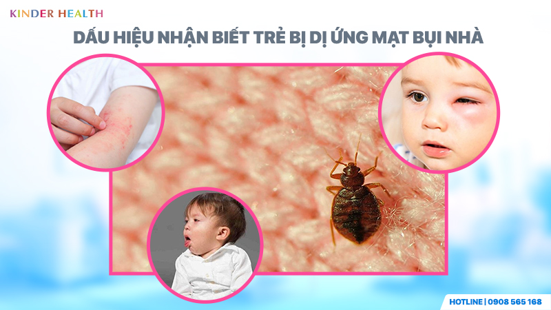 Dấu hiệu nhận biết trẻ bị dị ứng Mạt bụi nhà
