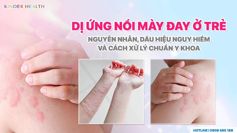 Dị ứng nổi mày đay ở trẻ: Nguyên nhân, Dấu hiệu và Cách xử lý chuẩn Y khoa