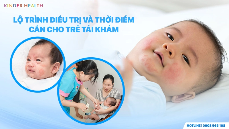 Lộ trình điều trị và thời điểm tái khám cho trẻ dị ứng sữa bò tại KinderHealth