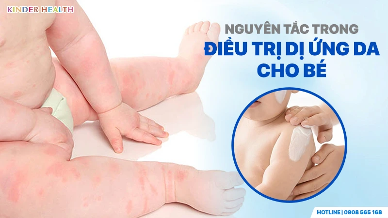 Nguyên tắc điều trị dị ứng da cho bé bao gồm việc chỉ định và sử dụng thuốc đúng cách tại KinderHealth
