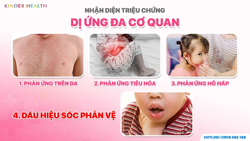 Nhận diện triệu chứng dị ứng đa cơ quan ở trẻ với phản ứng trên da, tiêu hóa, hô hấp và dấu hiệu sốc phản vệ