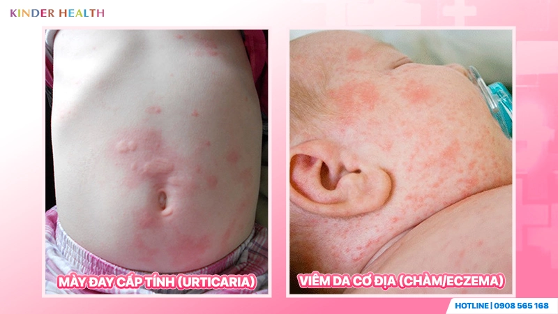 Phân biệt dấu hiệu Mày đay cấp tính và Viêm da cơ địa (Chàm Eczema) qua hình ảnh thực tế trên da trẻ em