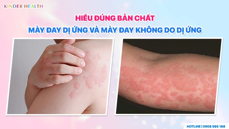 Hiểu đúng bản chất: Mày đay Dị ứng và Mày đay Không do Dị ứng