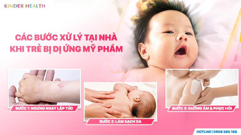 Các bước xử lý tại nhà khi trẻ bị dị ứng mỹ phẩm