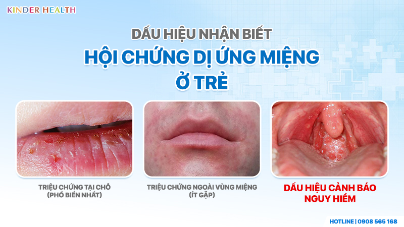 Dấu hiệu nhận biết Hội chứng dị ứng miệng ở trẻ