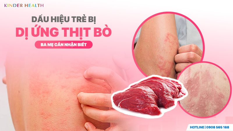 Dấu hiệu trẻ bị dị ứng thịt bò ba mẹ cần nhận biết
