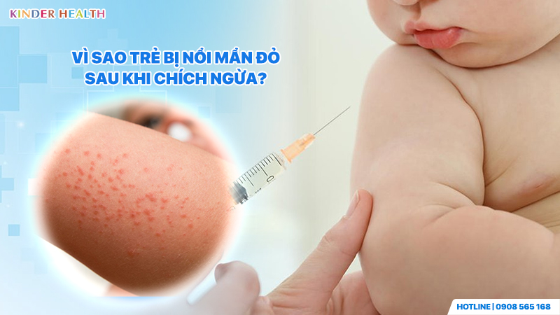 Vì sao trẻ bị nổi mẩn đỏ sau khi chích ngừa?