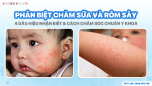 Phân biệt chàm sữa và rôm sảy