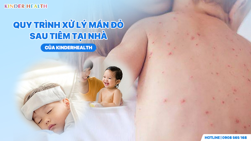 Quy trình xử lý mẩn đỏ sau tiêm tại nhà của KinderHealth