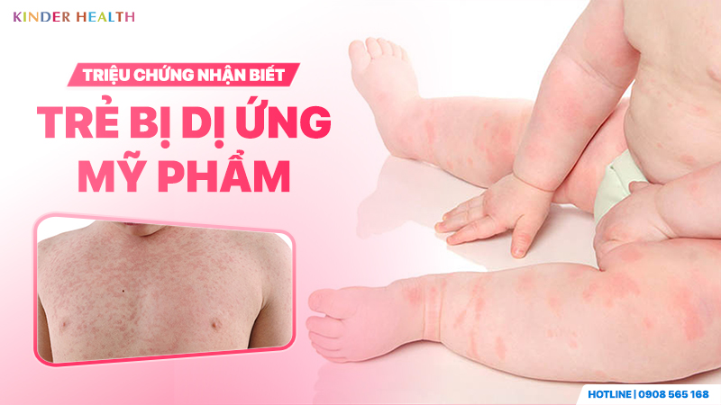 Triệu chứng nhận biết trẻ bị dị ứng mỹ phẩm