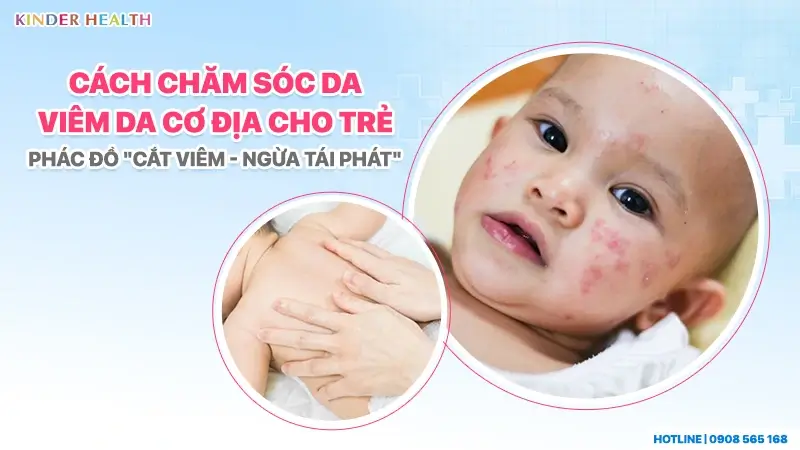 Hướng dẫn cách chăm sóc da viêm da cơ địa cho trẻ em với hình ảnh minh họa bé bị chàm ở má và thao tác thoa kem dưỡng
