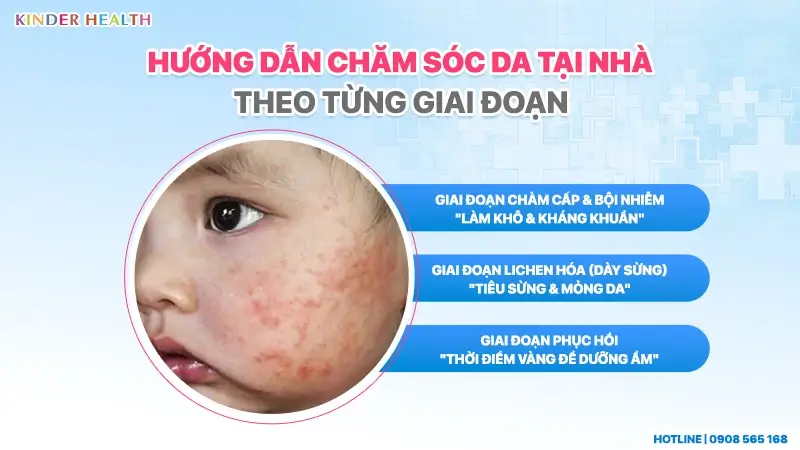 Hướng dẫn 3 giai đoạn chăm sóc da tại nhà cho trẻ bị viêm da cơ địa chuẩn y khoa.
