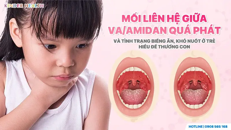 mối liên hệ mật thiết giữa VA/Amidan quá phát và tình trạng biếng ăn, khó nuốt ở trẻ