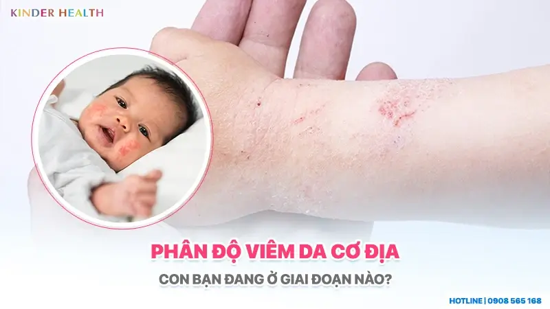 Minh họa các mức độ tổn thương để phân độ viêm da cơ địa ở trẻ sơ sinh và trẻ nhỏ