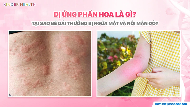 Dấu hiệu dị ứng phấn hoa ở bé gái