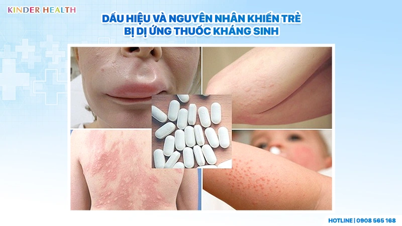 dấu hiệu và nguyên nhân trẻ bị dị ứng thuốc kháng sinh