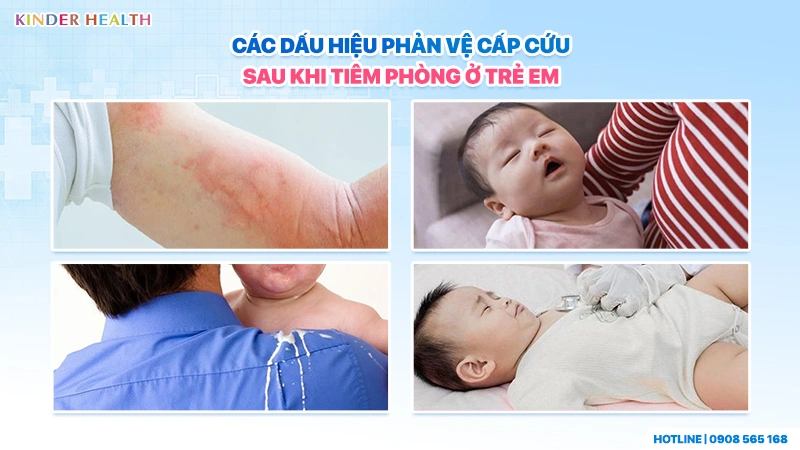 dấu hiệu phản vệ cấp cứu sau khi tiêm phòng ở trẻ: nổi mề đay diện rộng, nôn vọt ọc sữa, lờ đờ lịm đi và khó thở