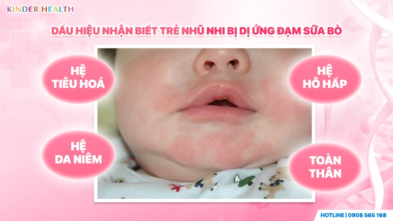 dấu hiệu trẻ nhũ nhi dị ứng đạm bò thể hiện qua 4 hệ cơ quan: da, tiêu hóa, hô hấp, toàn thân