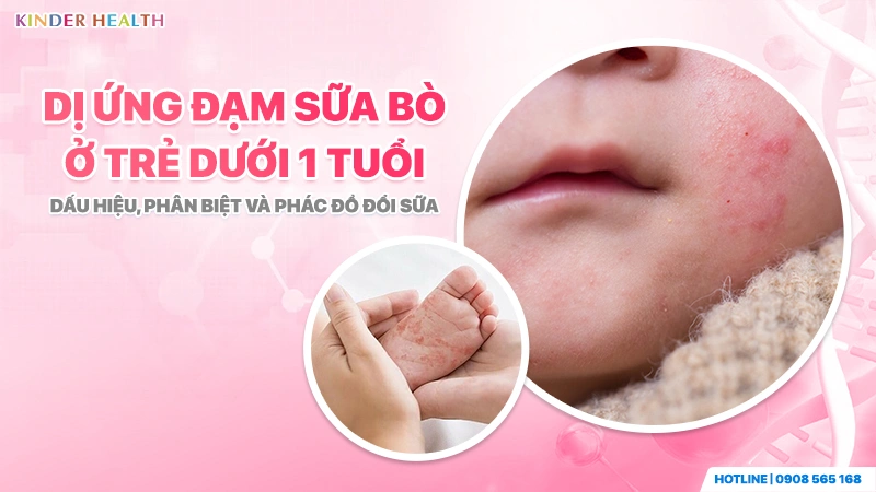 Dị Ứng Đạm Sữa Bò Ở Trẻ Dưới 1 Tuổi: Dấu Hiệu, Phân Biệt Và Phác Đồ Đổi Sữa