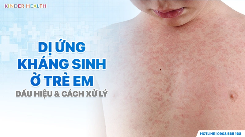 Dị Ứng Kháng Sinh Ở Trẻ Em: Dấu Hiệu Nhận Biết Và Cách Xử Lý An Toàn