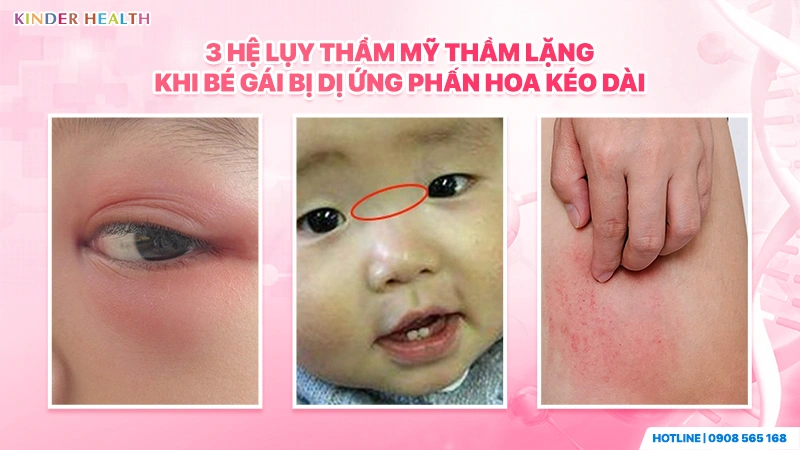 Hệ lụy thẩm mỹ khi bé gái bị dị ứng phấn hoa kéo dài
