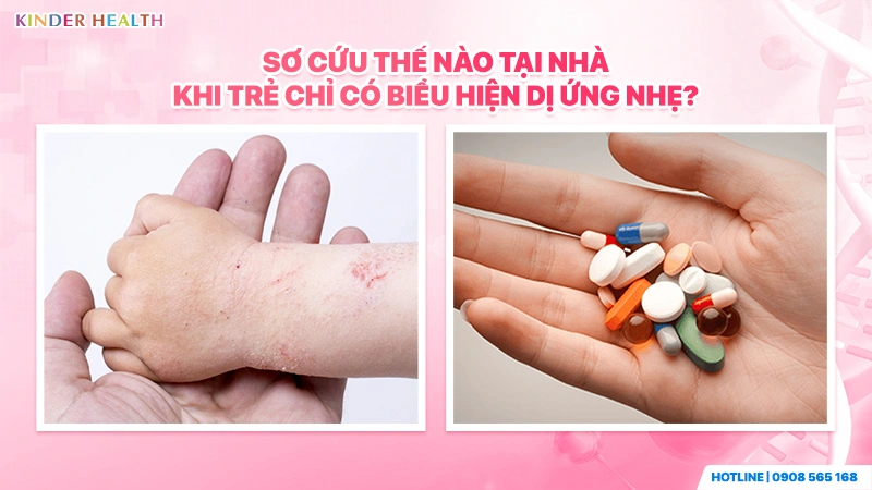 Sơ cứu thế nào tại nhà khi trẻ chỉ có biểu hiện dị ứng nhẹ?