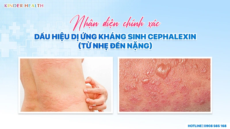 Dấu Hiệu Dị Ứng Kháng Sinh Cephalexin Ở Trẻ Nhỏ Và Phân Biệt Với Tác Dụng Phụ Của Thuốc 2 nhận diện các mức độ dị ứng cephalexin ờ trẻ từ nhẹ đến nặng