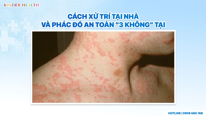 Dấu Hiệu Dị Ứng Kháng Sinh Cephalexin Ở Trẻ Nhỏ Và Phân Biệt Với Tác Dụng Phụ Của Thuốc 3 Phác đồ 3 Không điều trị dị ứng kháng sinh cho trẻ tại KinderHealth