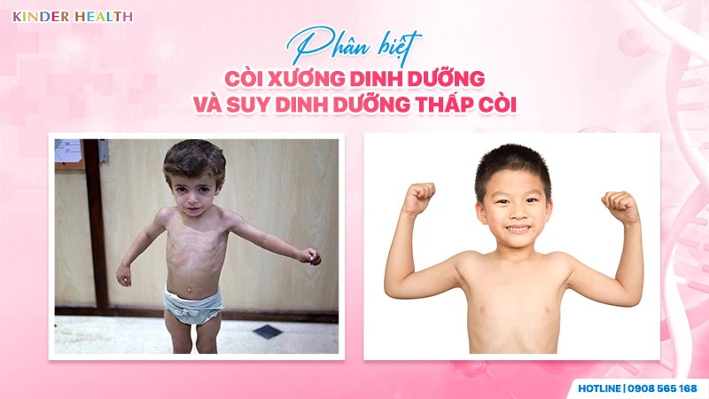 Thực Đơn Tăng Cân Cho Trẻ Còi Xương: Phác Đồ Tăng Đậm Độ Năng Lượng Chuẩn KinderHealth 2 Phân biệt Còi xương dinh dưỡng và Suy dinh dưỡng thấp còi