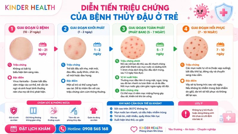 Diễn tiến triệu chứng của bệnh thủy đậu ở trẻ theo từng giai đoạn